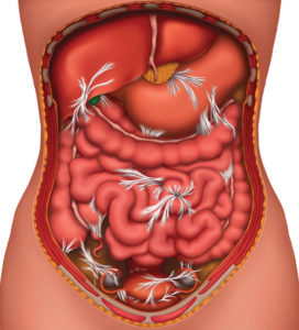 Abdominal Adhesions, Women's Health Treatment, North London