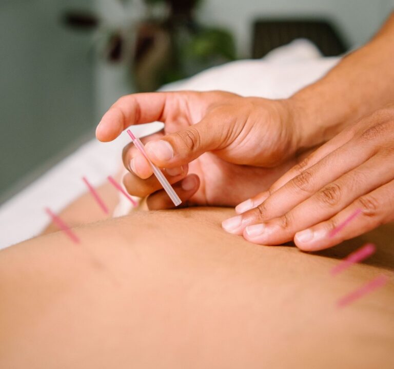 Back acupuncture treatment 2
