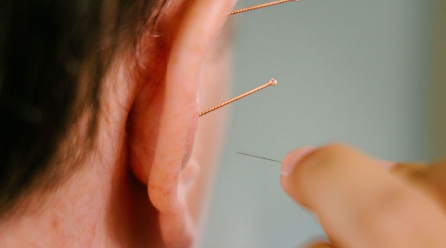 Ear acupuncture 2